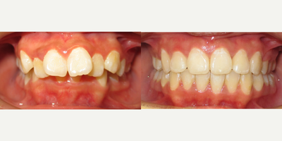 Braces before and after photo