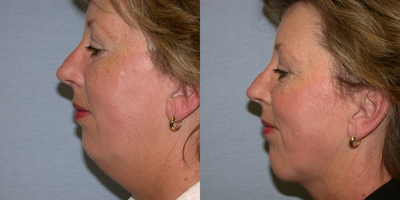 Laser Liposuction before and after photo