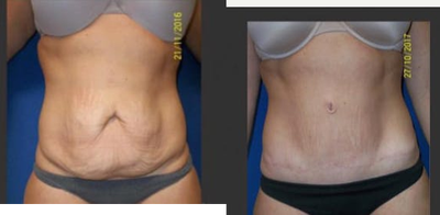 Tummy Tuck before and after photo