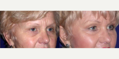 Brow Lift before and after photo