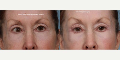 Brow Lift before and after photo