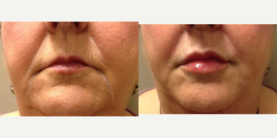 Dermal Fillers before and after photo