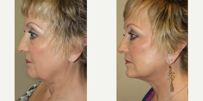Eyelid Surgery before and after photo