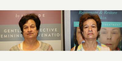 Fractora RF before and after photo