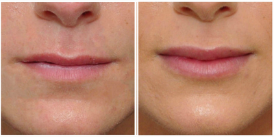 Lip Fillers before and after photo