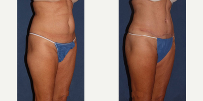 Tummy Tuck before and after photo