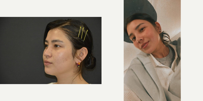 Asian Rhinoplasty before and after photo