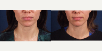 Botox before and after photo