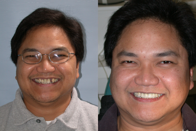Dental Implants before and after photo