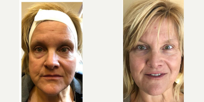 Dermal Fillers before and after photo