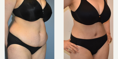 Liposuction before and after photo