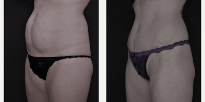 Tummy Tuck before and after photo