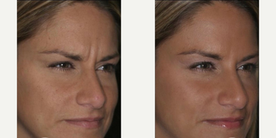 Botox before and after photo