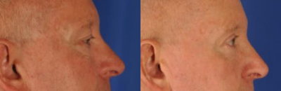 Eyelid Surgery before and after photo
