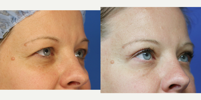 Eyelid Surgery before and after photo