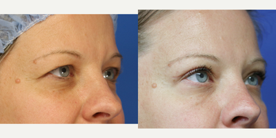 Eyelid Surgery before and after photo