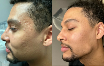 Microneedling before and after photo