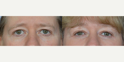 Brow Lift before and after photo