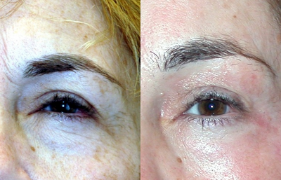 Chemical Peel before and after photo