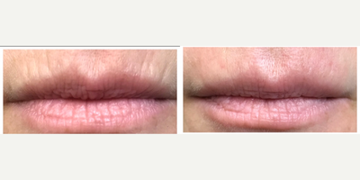 Dermal Fillers before and after photo