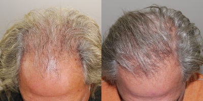 FUE Hair Transplant before and after photo