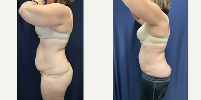 Mini Tummy Tuck before and after photo