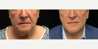 Neck Lift before and after photo