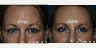 Brow Lift before and after photo
