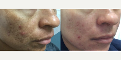 Laser Resurfacing before and after photo