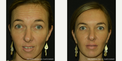 Botox before and after photo