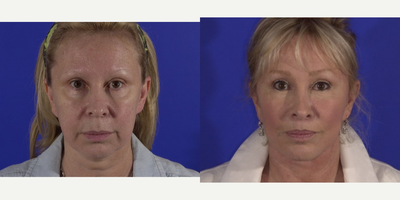 Facelift before and after photo
