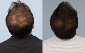 Hair Loss Treatment before and after photo