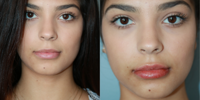 Lip Fillers before and after photo