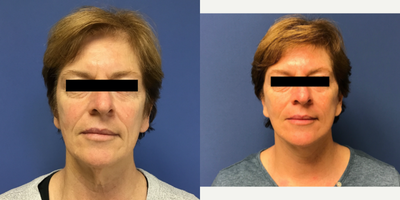 Mini Facelift before and after photo