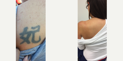 Tattoo Removal before and after photo