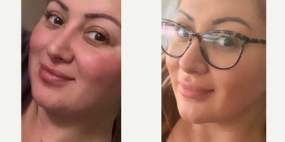 Chin Liposuction before and after photo