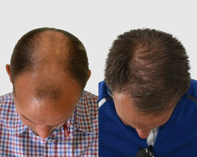 Hair Loss Treatment before and after photo