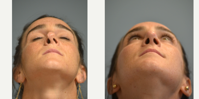 Rhinoplasty before and after photo