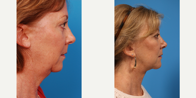 Facelift before and after photo