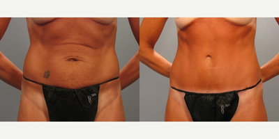 Tummy Tuck before and after photo