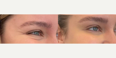 Botox before and after photo