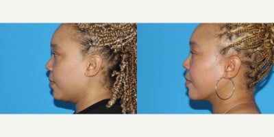 Chin Liposuction before and after photo