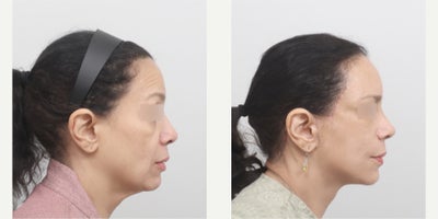 Chin Liposuction before and after photo