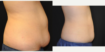 CoolSculpting before and after photo