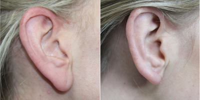 Ear Surgery before and after photo