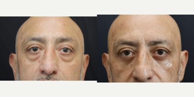 Eyelid Surgery before and after photo