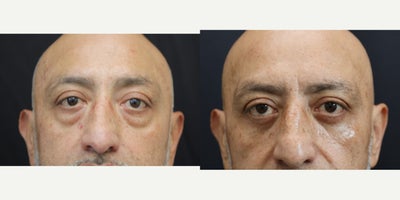 Eyelid Surgery before and after photo