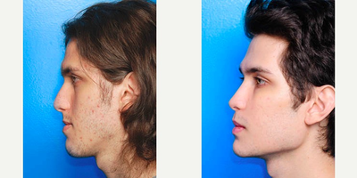 Jaw Surgery before and after photo