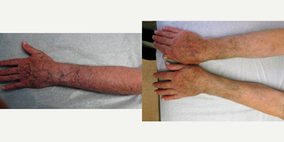 Sclerotherapy before and after photo