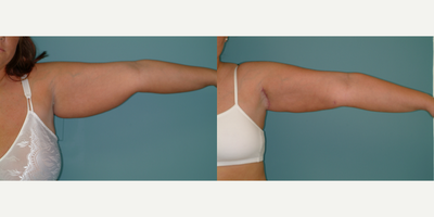 Arm Lift before and after photo